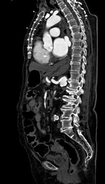 Abdominal aortic aneurysm with thrombus fissuration (Radiopaedia 73192-83919 Sagittal C+ arterial phase 62).jpg