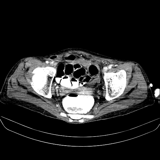 File:Abdominal collection due to previous cecal perforation (Radiopaedia 80831-94320 Axial C+ portal venous phase 185).jpg
