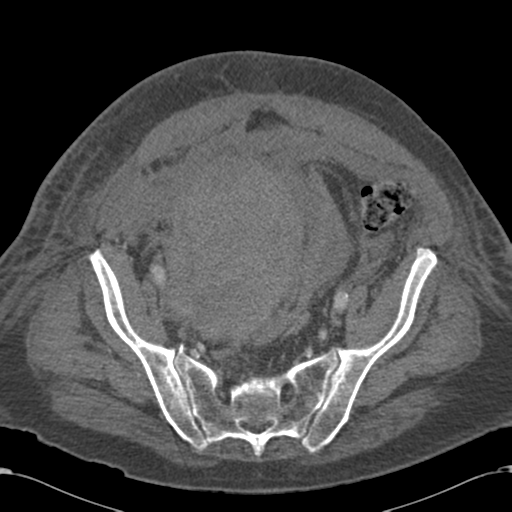 Abdominal hematoma (Radiopaedia 33614-34715 Axial C+ portal venous phase 102).png