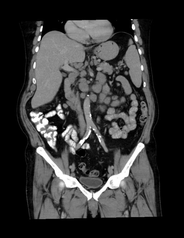 Abdominal lymphoma - with sandwich sign (Radiopaedia 53486-59492 C+ portal venous phase 31).jpg