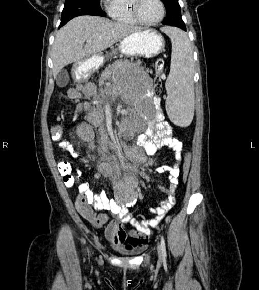 Abdominal lymphoma with sandwich sign (Radiopaedia 84378-99704 Coronal C+ portal venous phase 16).jpg