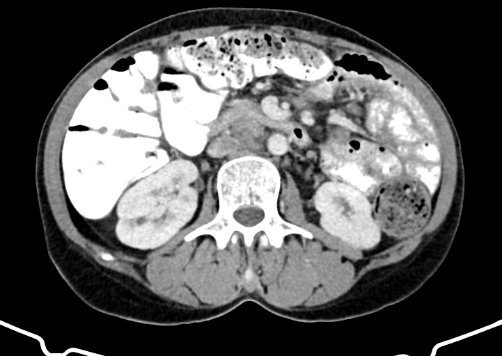 Abdominal wall and retroperitoneal tuberculosis (Radiopaedia 88137-104729 Axial C+ portal venous phase 88).jpg