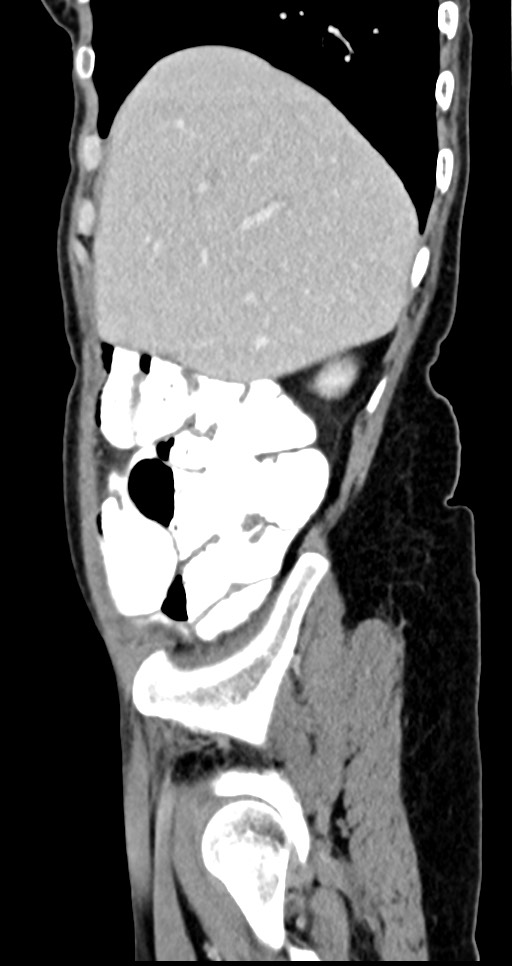 Abdominal wall and retroperitoneal tuberculosis (Radiopaedia 88137-104729 Sagittal C+ portal venous phase 120).jpg