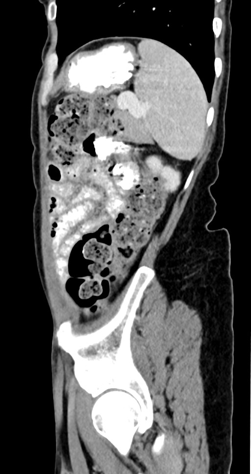 Abdominal wall and retroperitoneal tuberculosis (Radiopaedia 88137-104729 Sagittal C+ portal venous phase 35).jpg