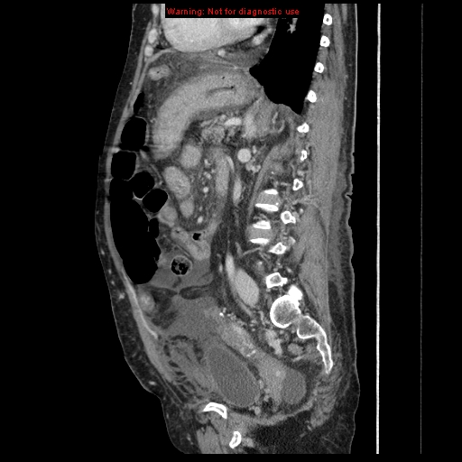 Abdominal wall hematoma (Radiopaedia 9427-10112 Sagittal C+ portal venous phase 43).jpg