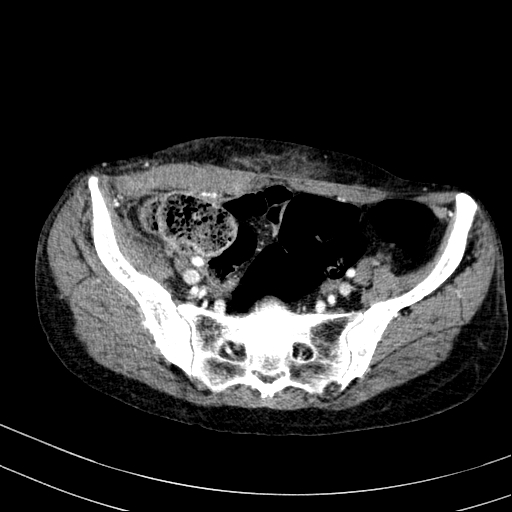 Abdominal wall hematoma with active bleeding (Radiopaedia 83915-99117 Axial renal cortical phase 105).jpg