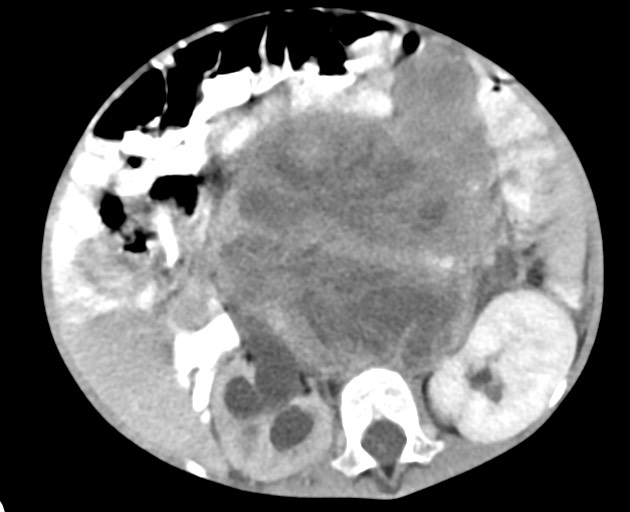 Abdominopelvic rhabdomyosarcoma (Radiopaedia 78356-90984 Axial C+ portal venous phase 82).jpg