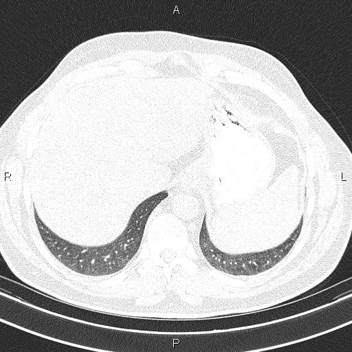 Aberrant right subclavian artery (Radiopaedia 87093-103354 Axial lung window 95).jpg