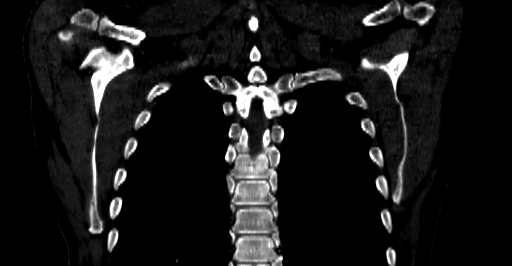 Accesory rib joint (Radiopaedia 71987-82452 Coronal bone window 52).jpg