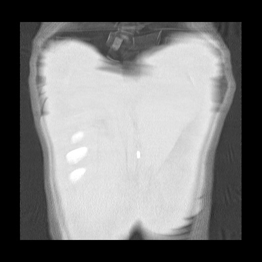 File:Accessory left horizontal fissure with lingular pneumonia (Radiopaedia 53763-59843 Coronal lung window 44).jpg