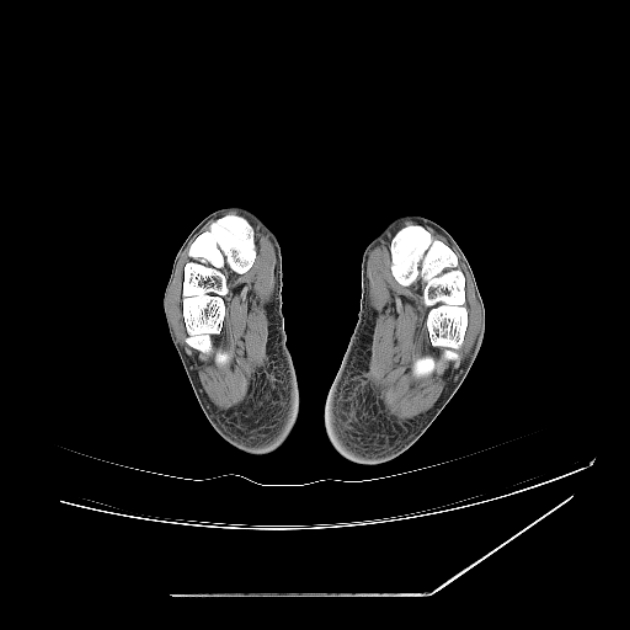Accessory soleus muscle (Radiopaedia 61069-68943 Axial non-contrast 75).jpg