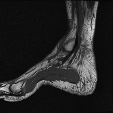 File:Achilles tendon tear (Radiopaedia 77615-89819 Sagittal T1 3).jpg