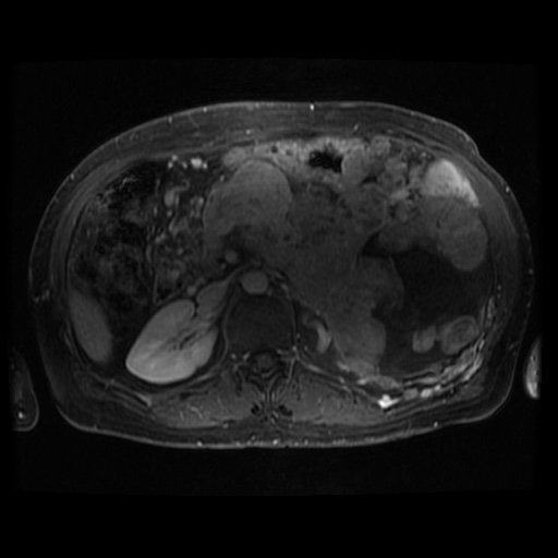 Acinar cell carcinoma of the pancreas (Radiopaedia 75442-86668 Axial T1 C+ fat sat 53).jpg
