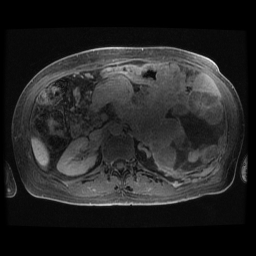 Acinar cell carcinoma of the pancreas (Radiopaedia 75442-86668 Axial late phase (~30 mins) 51).jpg