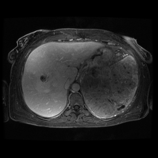 Acinar cell carcinoma of the pancreas (Radiopaedia 75442-86668 D 107).jpg