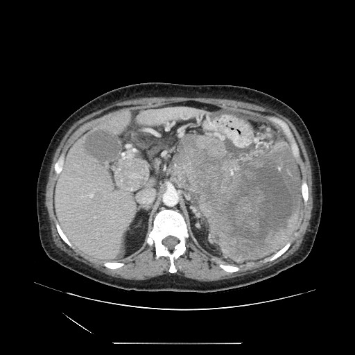 File:Acinar cell carcinoma of the pancreas (Radiopaedia 75442-86669 Axial C+ portal venous phase 41).jpg