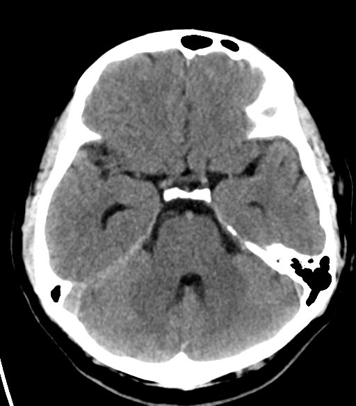 File:Acoustic schwannoma (Radiopaedia 33045-34065 Axial non-contrast 8).png