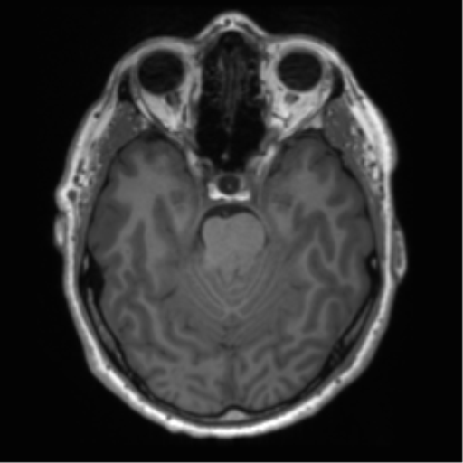 File:Acoustic schwannoma (Radiopaedia 50846-56358 Axial T1 36).png