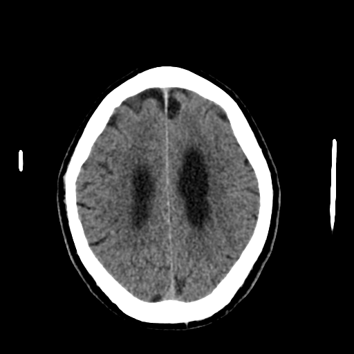 File:Acoustic schwannoma (Radiopaedia 55729-62280 Axial non-contrast 25).png