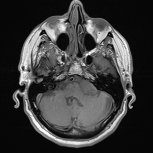 File:Acoustic schwannoma (Radiopaedia 55729-62281 T1 6).png