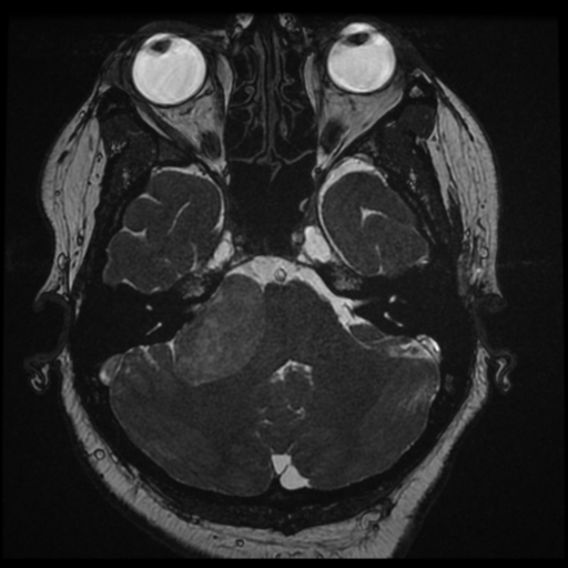 Acoustic schwannoma (Radiopaedia 57574-64536 Axial T2 35).png