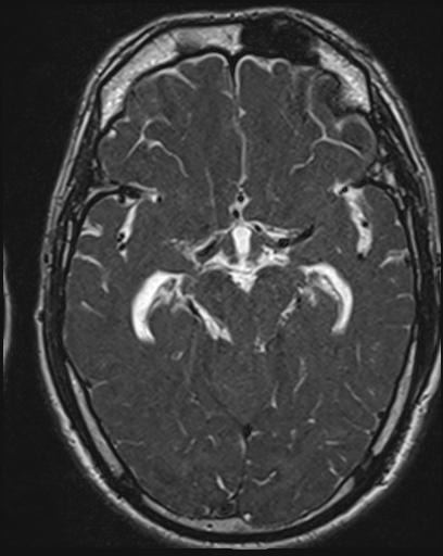File:Acoustic schwannoma - probable (Radiopaedia 20386-20292 Axial T1 62).jpg