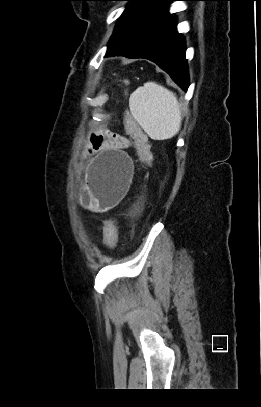 Active Crohn disease (Radiopaedia 59394-66750 Sagittal C+ portal venous phase 9).jpg