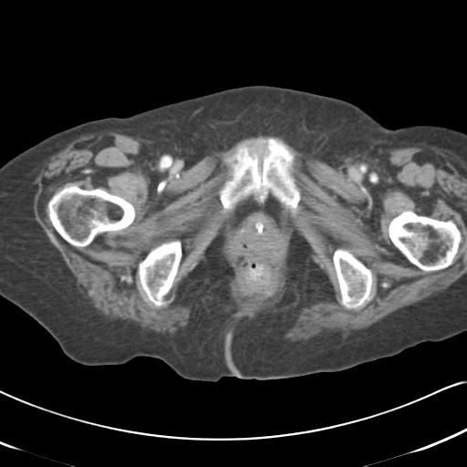 Active bleeding from duodenal ulcer with embolization (Radiopaedia 34216-35481 C 70).png