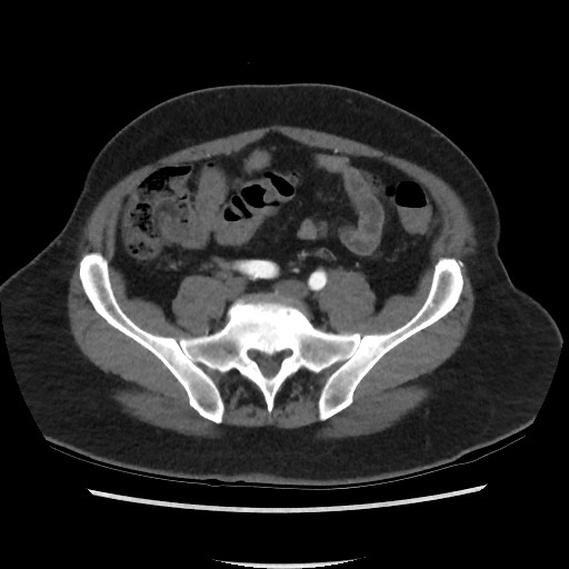 Active colonic bleed on CT (Radiopaedia 49765-55025 Axial C+ arterial phase 59).jpg