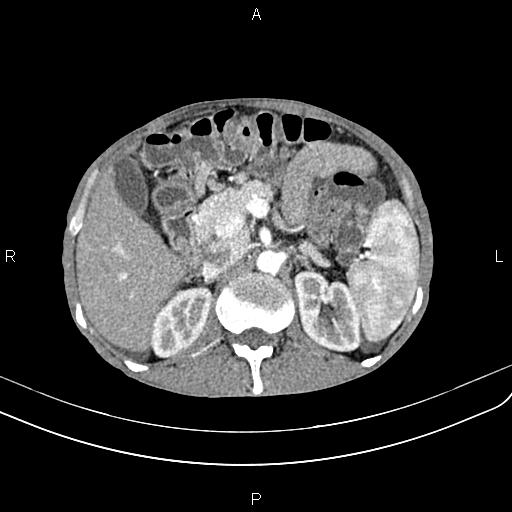 Active crohn disease (Radiopaedia 87133-103397 Axial C+ arterial phase 36).jpg