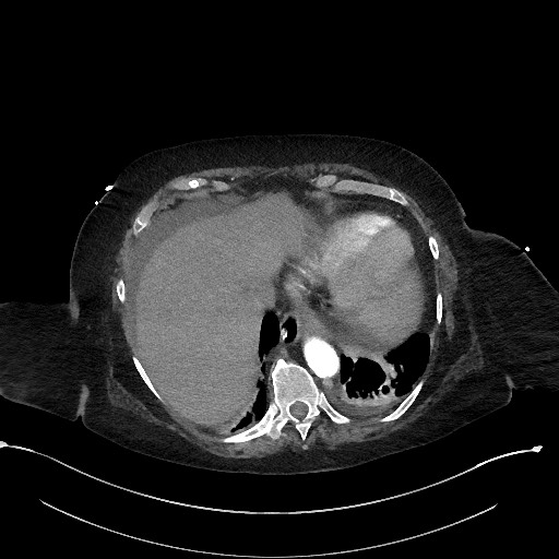 File:Active renal extravasation with large subcapsular and retroperitoneal hemorrhage (Radiopaedia 60975-68796 Axial 167).jpg