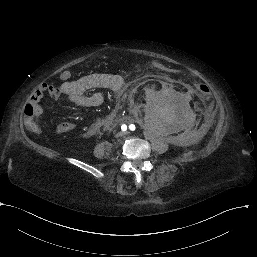 Active renal extravasation with large subcapsular and retroperitoneal hemorrhage (Radiopaedia 60975-68796 Axial C+ arterial phase 115).jpg
