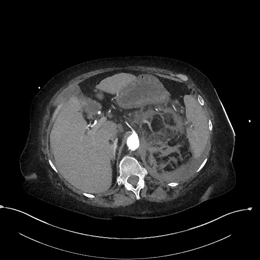 File:Active renal extravasation with large subcapsular and retroperitoneal hemorrhage (Radiopaedia 60975-68796 Axial C+ arterial phase 54).jpg