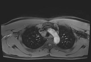 File:Active right ventricular cardiac sarcoidosis (Radiopaedia 55596-62100 Axial Post contrast Dixon 11).jpg