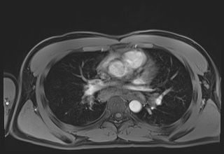 Active right ventricular cardiac sarcoidosis (Radiopaedia 55596-62100 Axial Post contrast Dixon 32).jpg