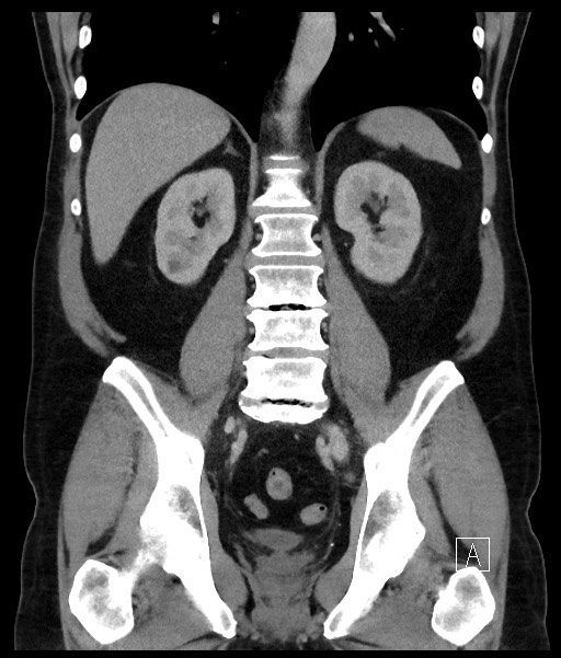 Acute-on-chronic pancreatitis (Radiopaedia 67286-76656 Coronal C+ portal venous phase 50).jpg