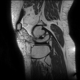 Acute-on-chronic transient lateral patellar dislocation with trochlear dysplasia (Radiopaedia 84099-99349 Sagittal PD 127).jpg
