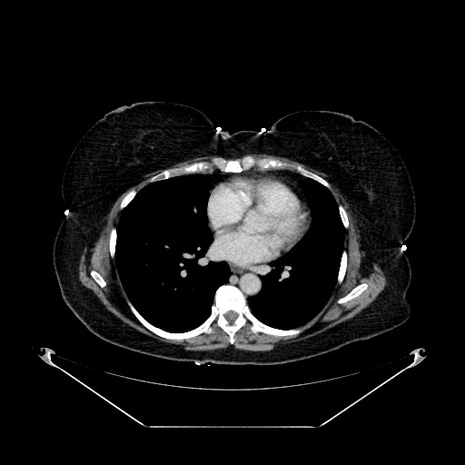 File:Acute appendicitis, heterotaxy syndrome (Radiopaedia 66884-76202 Axial C+ portal venous phase 1).jpg