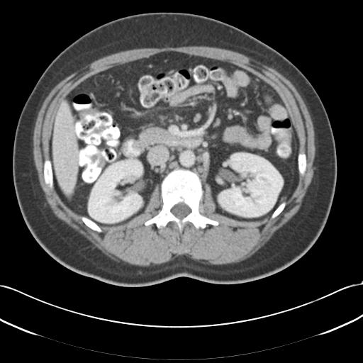 File:Acute appendicitis (Radiopaedia 30297-30934 Axial C+ portal venous phase 32).jpg