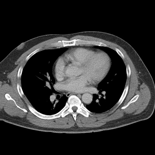 Acute appendicitis (Radiopaedia 48511-53463 Axial C+ portal venous phase 3).jpg