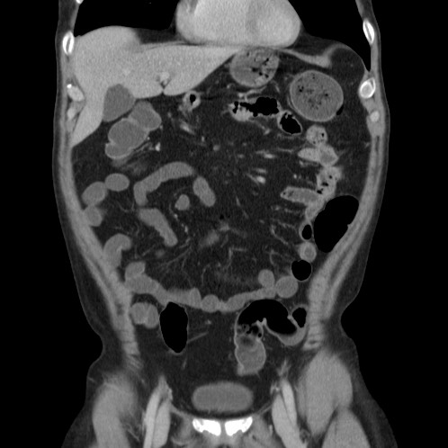 Acute appendicitis (Radiopaedia 66513-75790 Coronal C+ portal venous phase 16).jpg