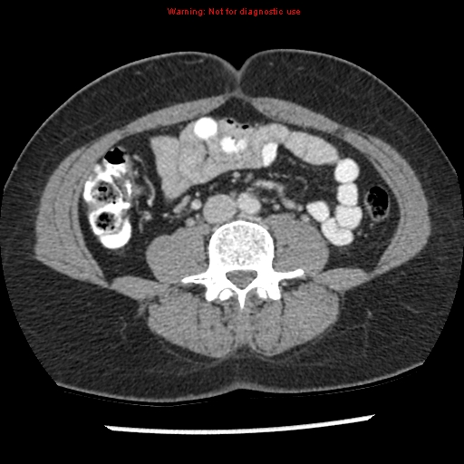 File:Acute appendicitis (Radiopaedia 7966-8812 C+ portal venous phase 27).jpg
