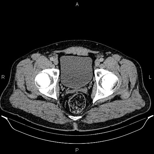 File:Acute appendicitis (Radiopaedia 84780-100240 Axial C+ portal venous phase 103).jpg