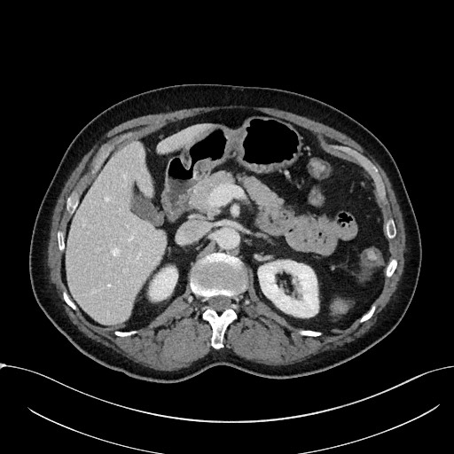 Acute appendicitis - large appendicoliths (Radiopaedia 61805-69820 Axial C+ portal venous phase 41).jpg