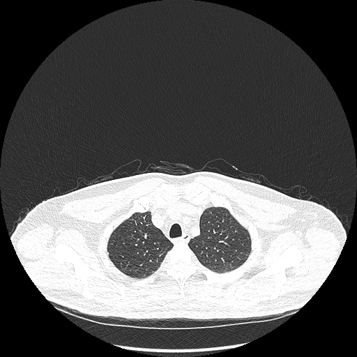 Acute appendicitis and COVID 19 pneumonia (Radiopaedia 76604-88380 Axial lung window 12).jpg