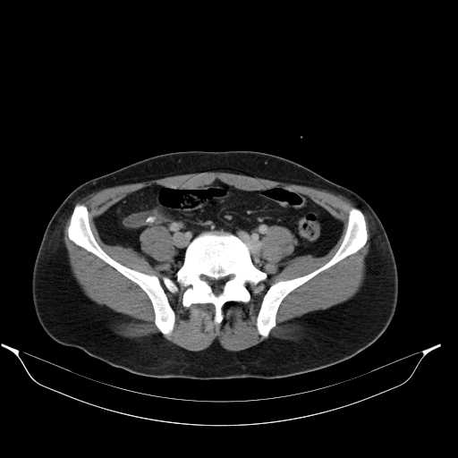 File:Acute appendicitis with appendicoliths (Radiopaedia 21148-21062 Axial C+ portal venous phase 13).jpg