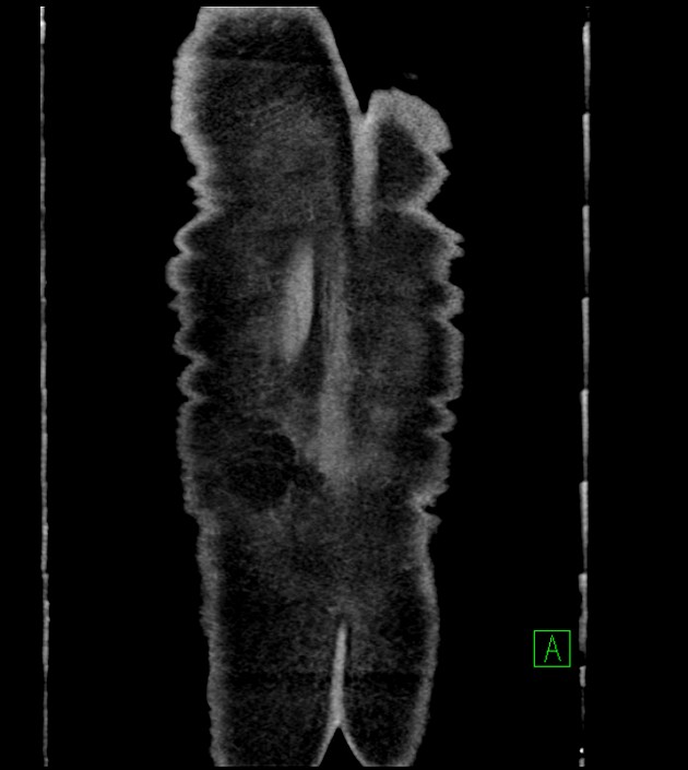 Acute arterial mesenteric ischemia (Radiopaedia 78238-90828 Coronal C+ portal venous phase 89).jpg