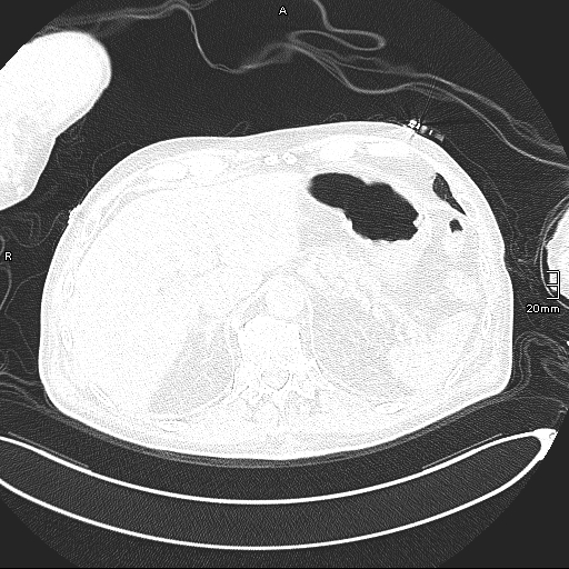 Acute aspiration pneumonitis (Radiopaedia 55642-62166 Axial lung window 145).jpg