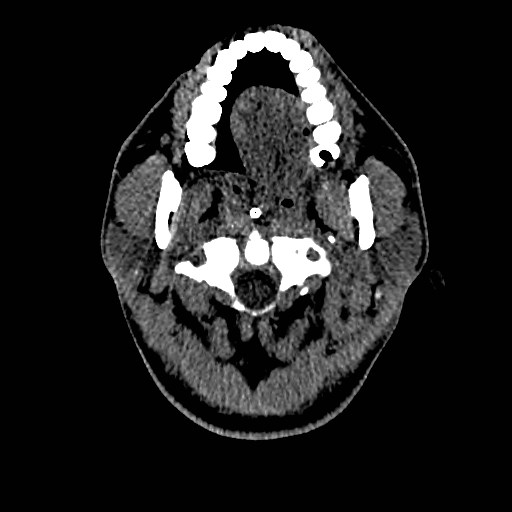 Acute basilar artery occlusion (Radiopaedia 43582-46985 Axial non-contrast 14).jpg