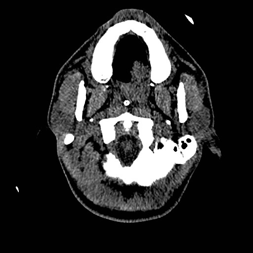 Acute basilar artery occlusion (Radiopaedia 43582-46985 Axial non-contrast 23).jpg